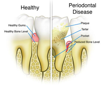 Gum Disease